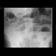 Ileus, small bowel obstruction: X-ray - Plain radiograph